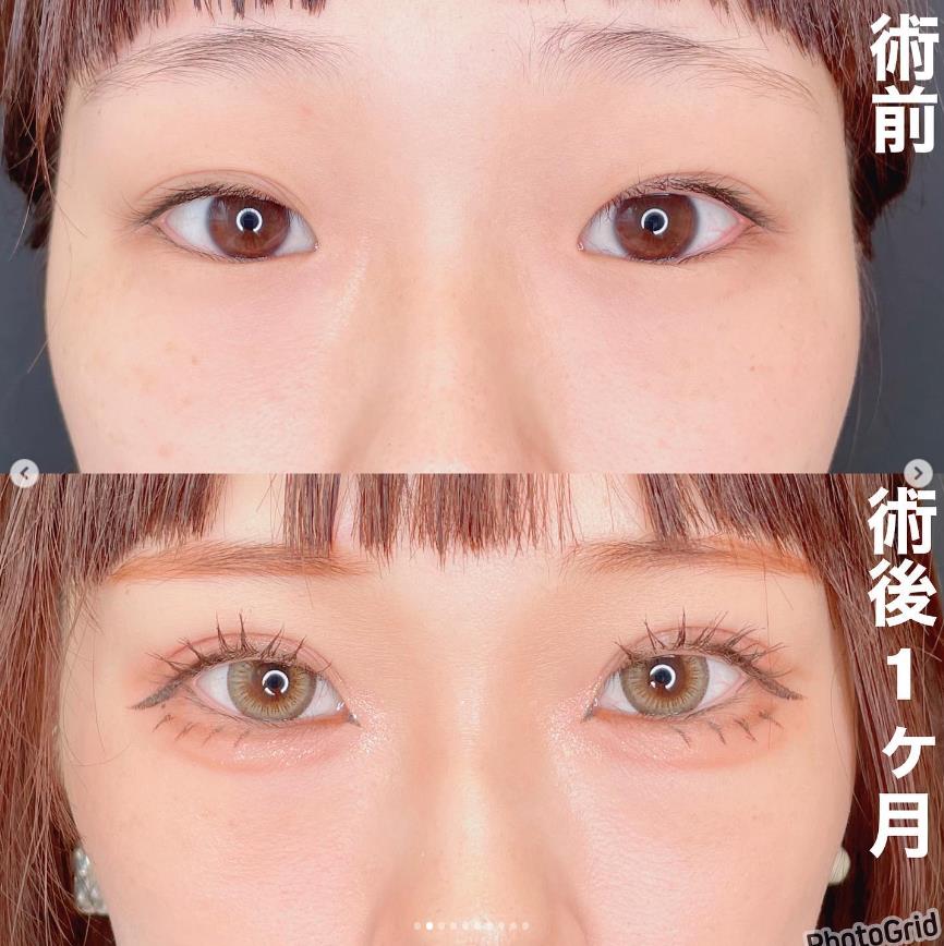 双眼皮手术