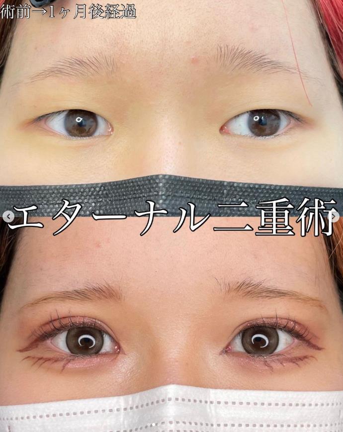 双眼皮手术