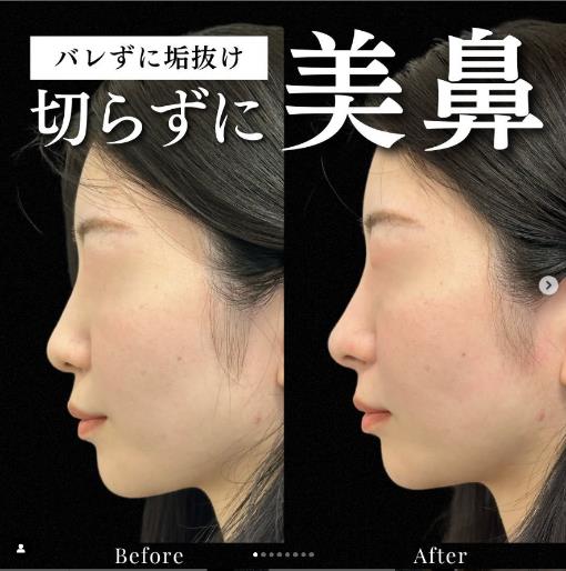 玻尿酸填充