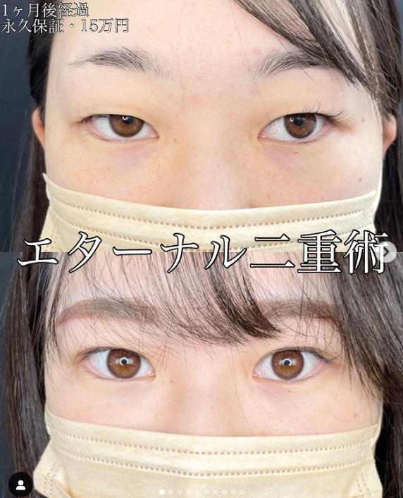 双眼皮手术