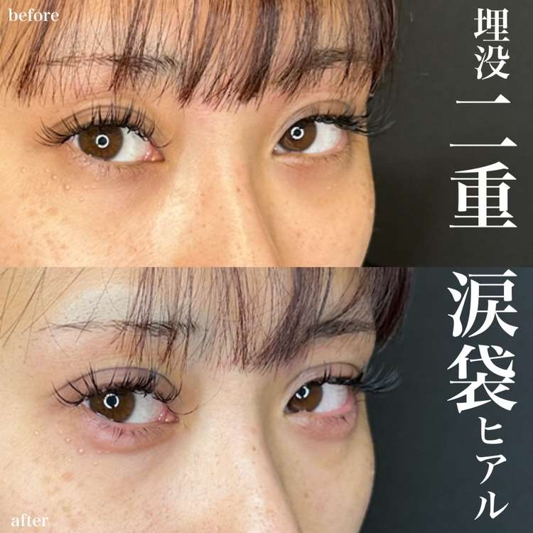 双眼皮手术