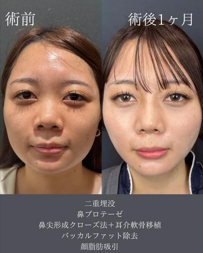鼻综合整形 + 鼻梁整形 - 硅胶假体 + 鼻尖整形 - 切开法 + 面部吸脂