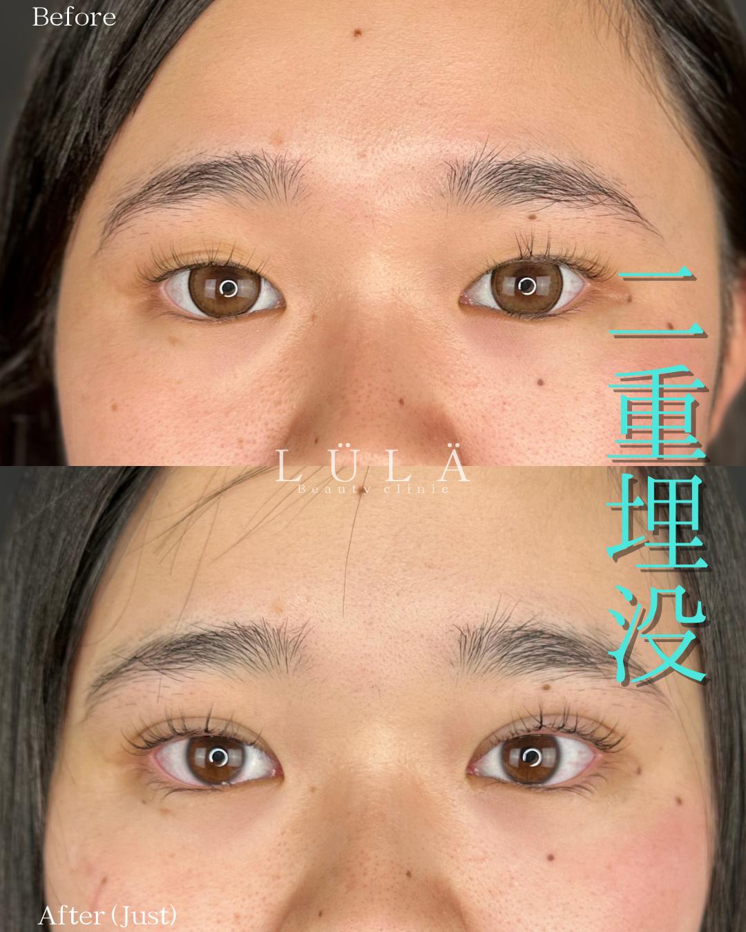 双眼皮手术