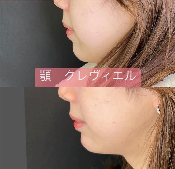 玻尿酸填充