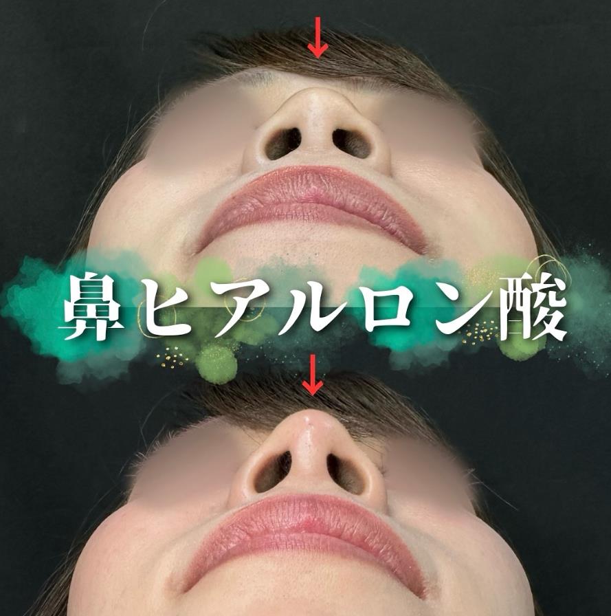玻尿酸填充