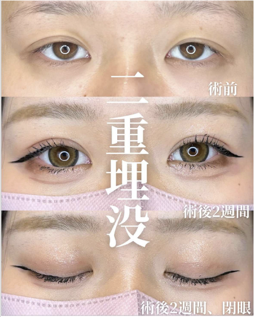 双眼皮手术