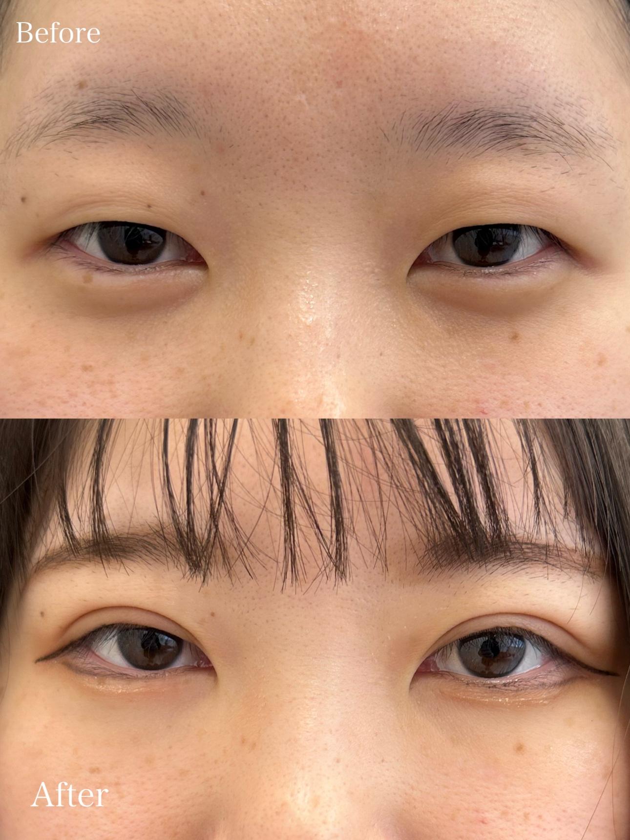 双眼皮手术