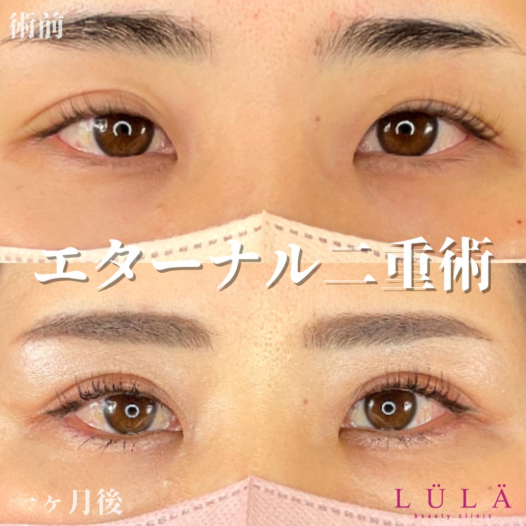 双眼皮手术