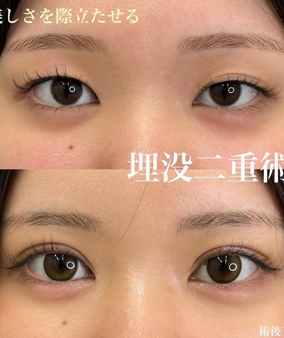 双眼皮手术