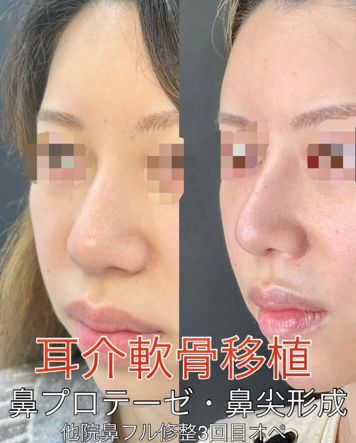 鼻综合整形 + 鼻梁整形 - 硅胶假体 + 鼻尖整形 - 切开法