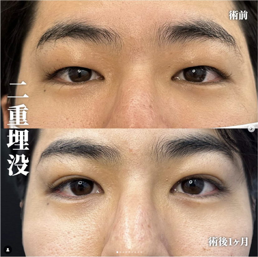 双眼皮手术