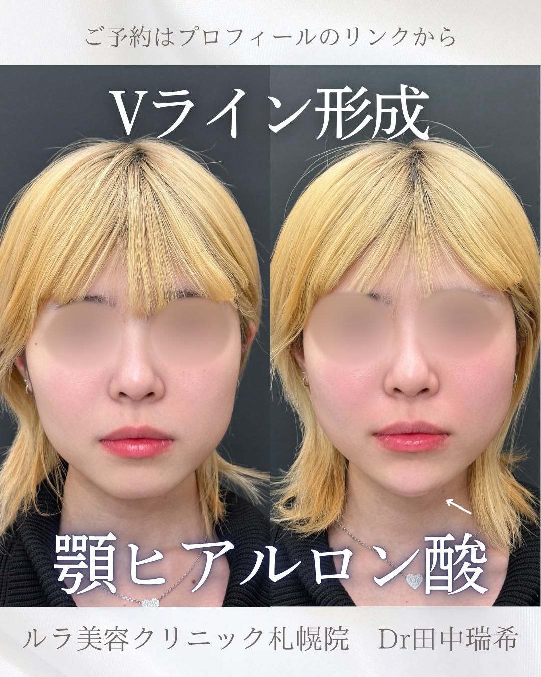 玻尿酸填充