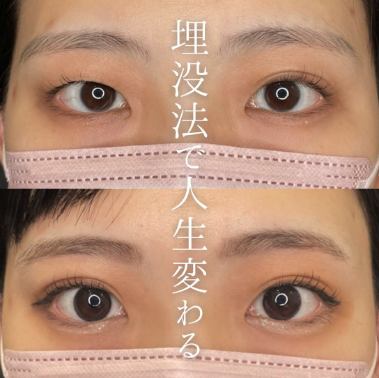 双眼皮手术