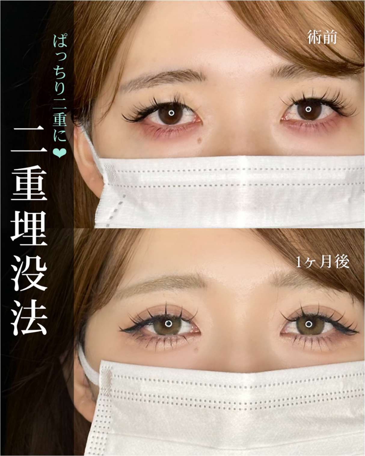 双眼皮手术
