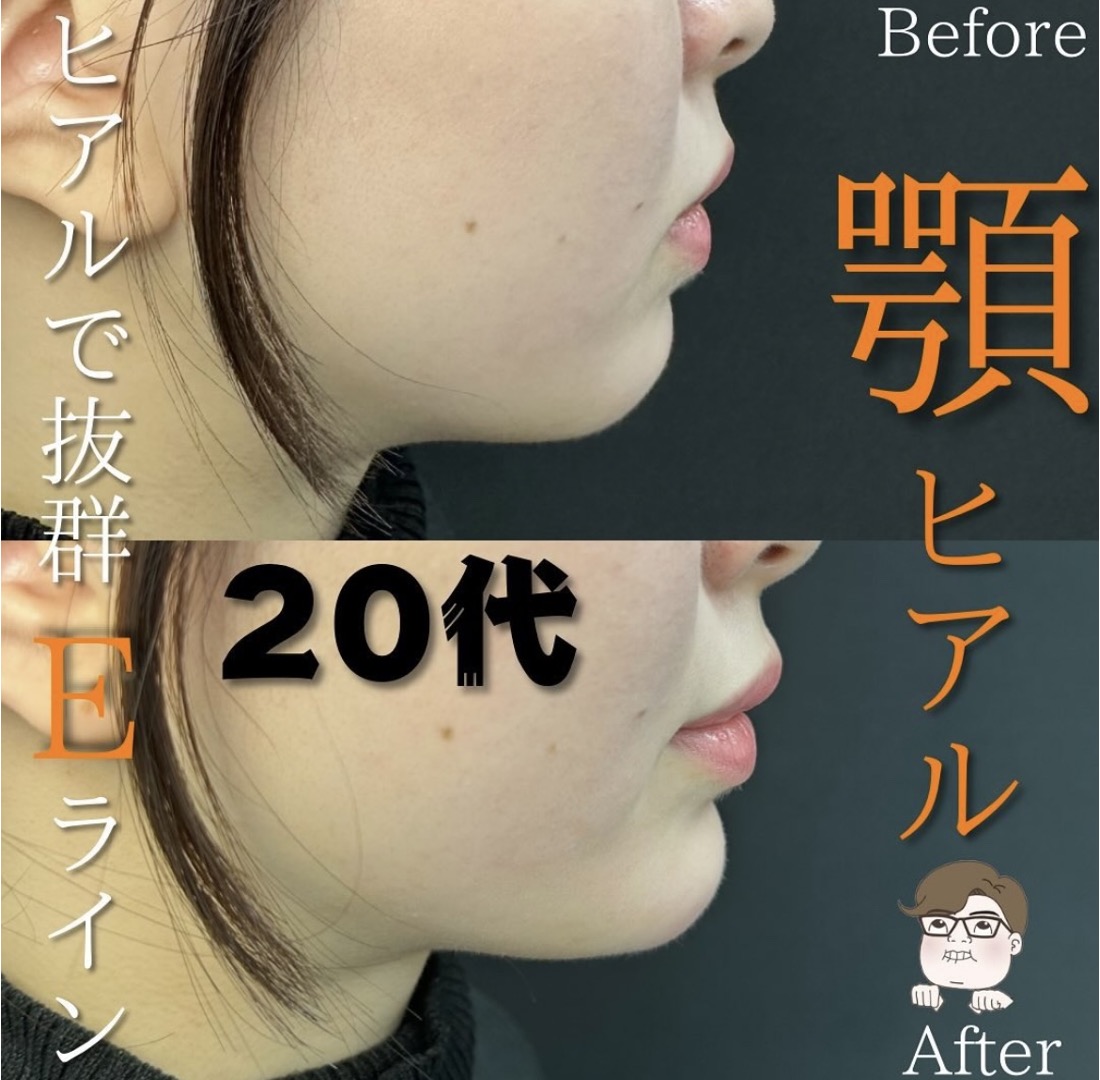 玻尿酸填充