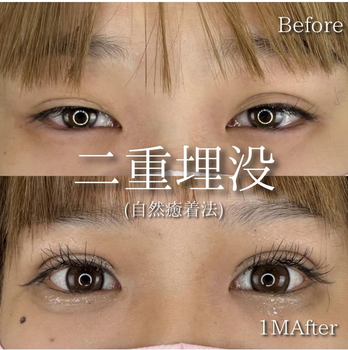 双眼皮手术