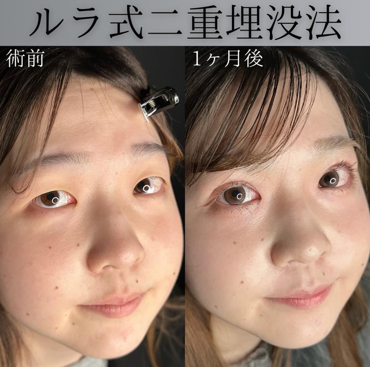 双眼皮手术