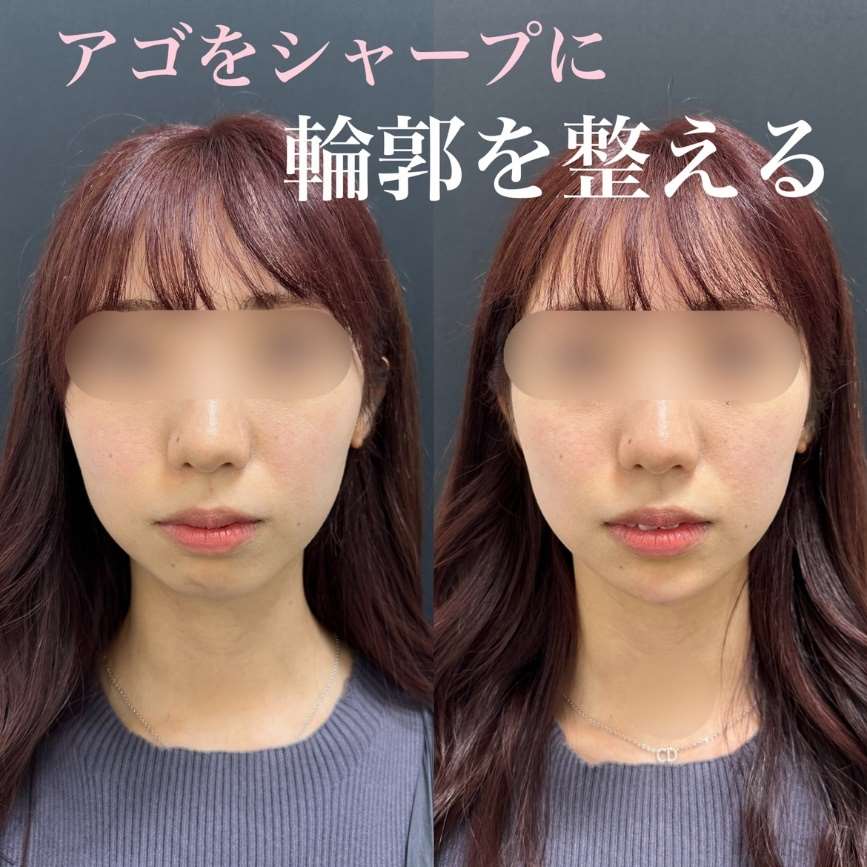 玻尿酸填充