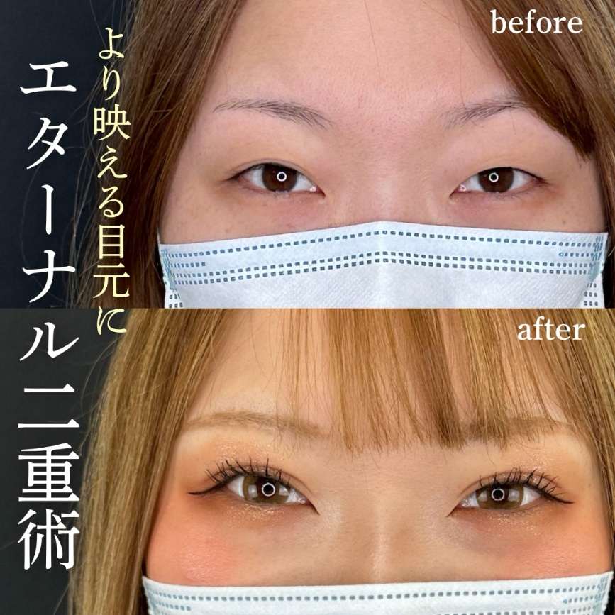 双眼皮手术