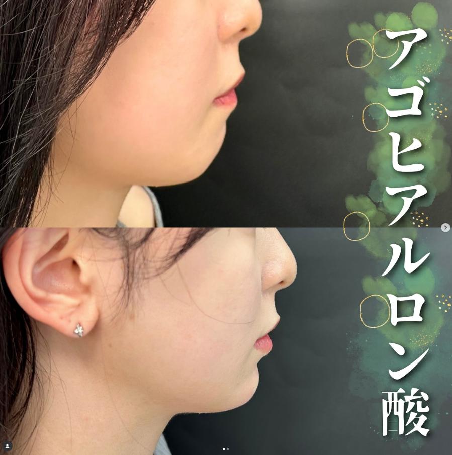 玻尿酸填充