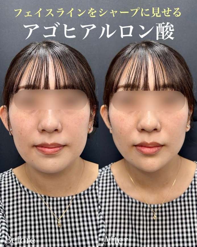 玻尿酸填充