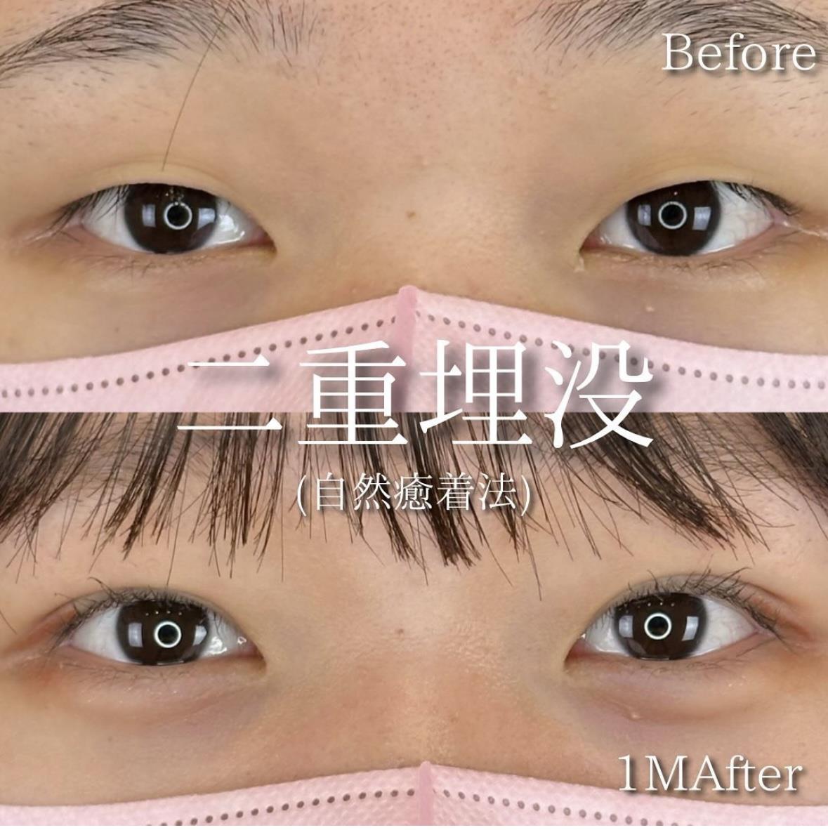 双眼皮手术