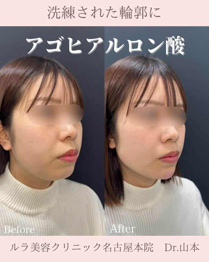 玻尿酸填充