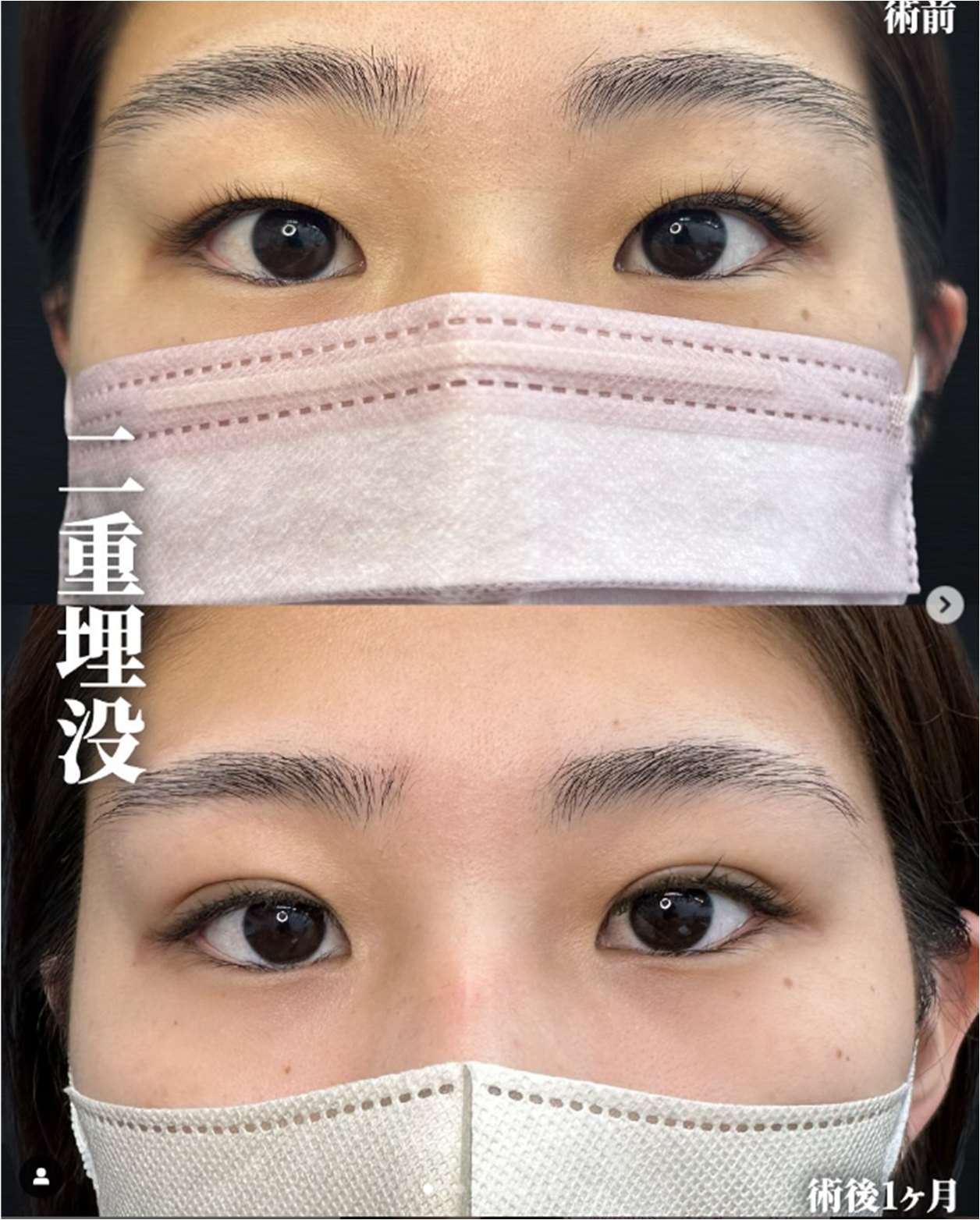 双眼皮手术