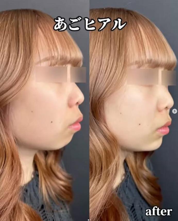 玻尿酸填充