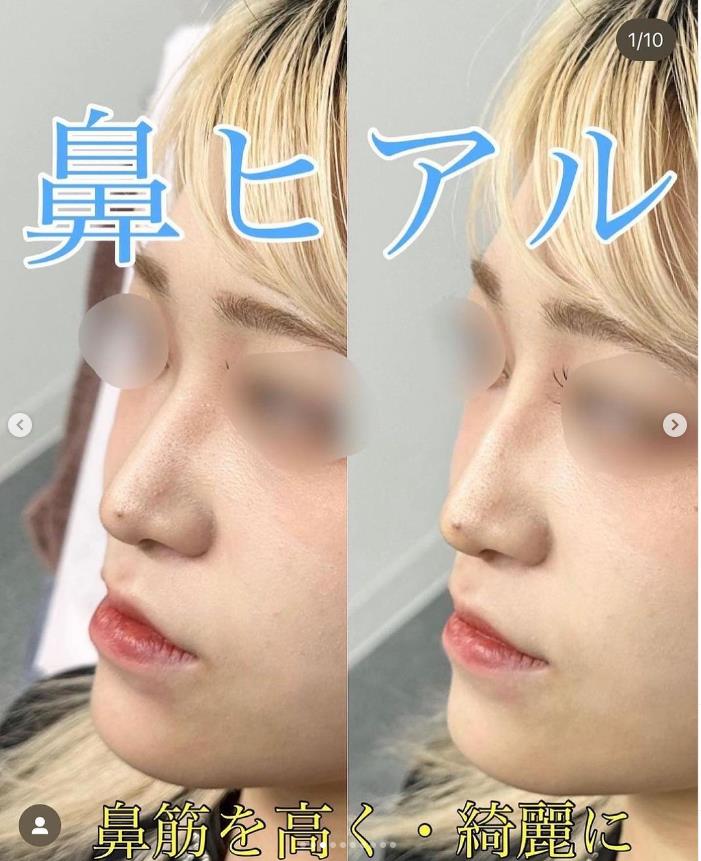玻尿酸填充