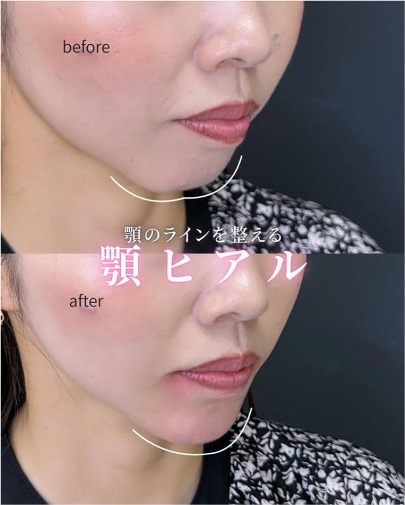 玻尿酸填充