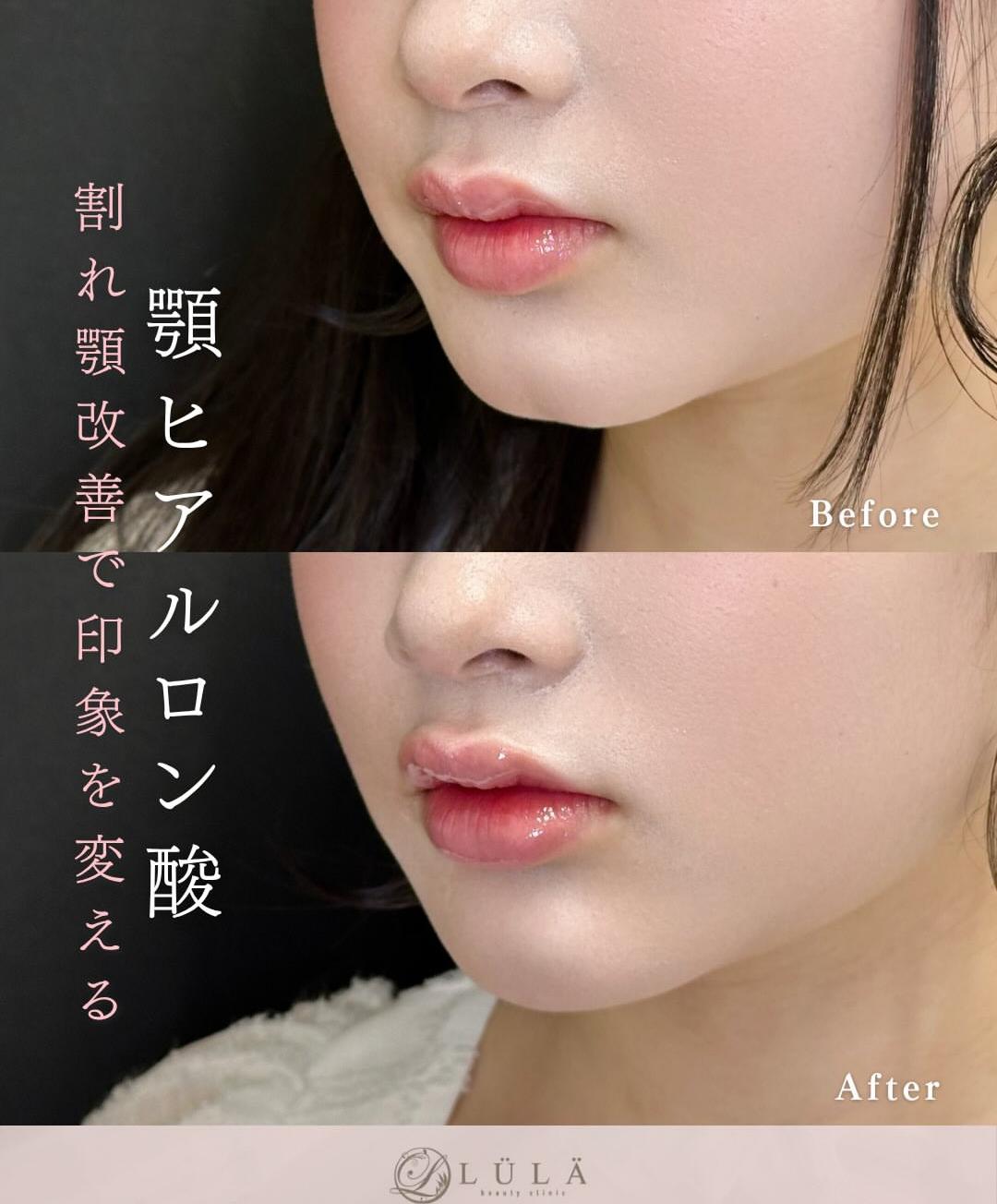 玻尿酸填充