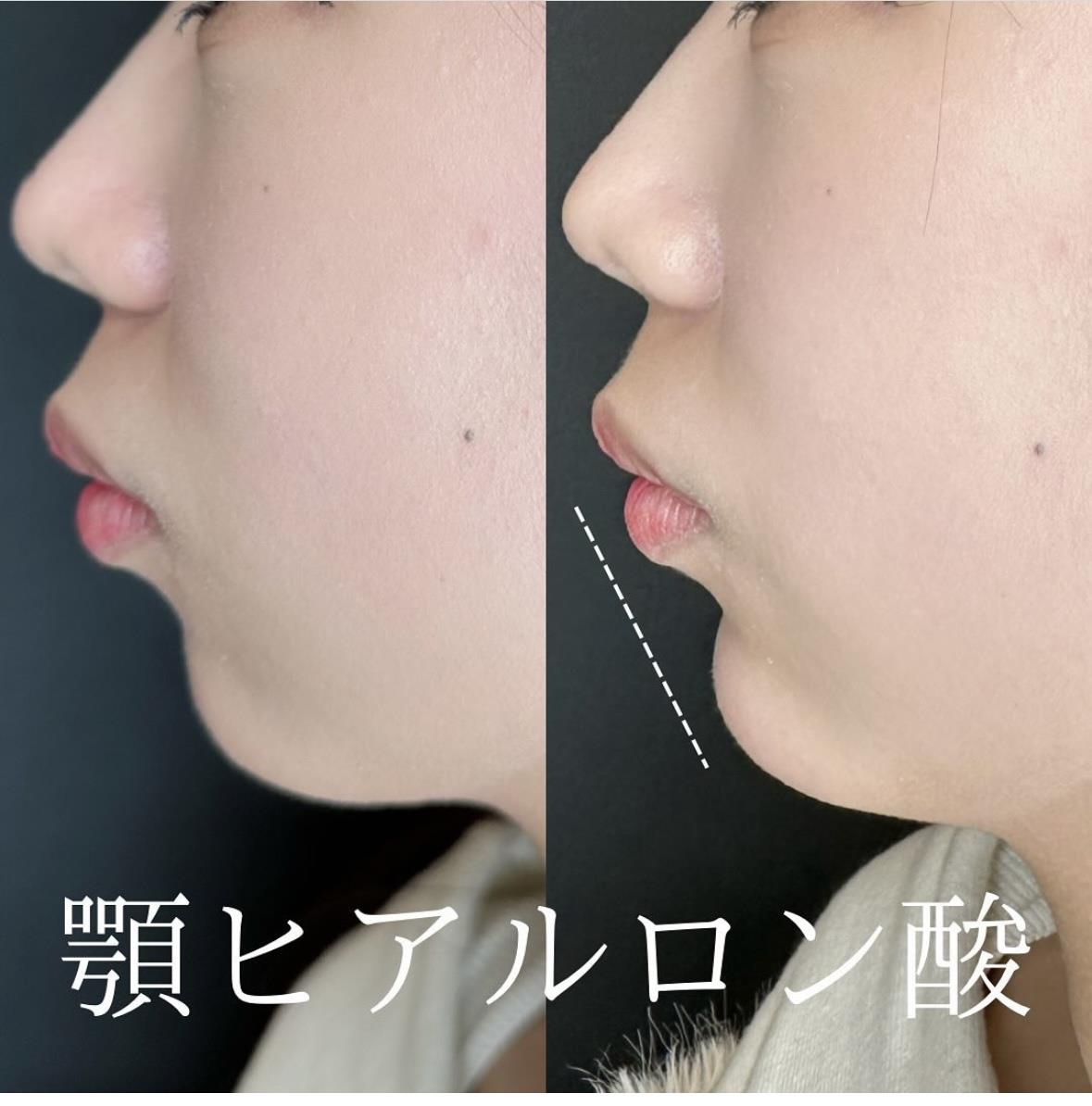 玻尿酸填充