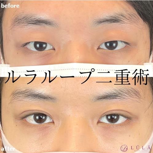 双眼皮手术