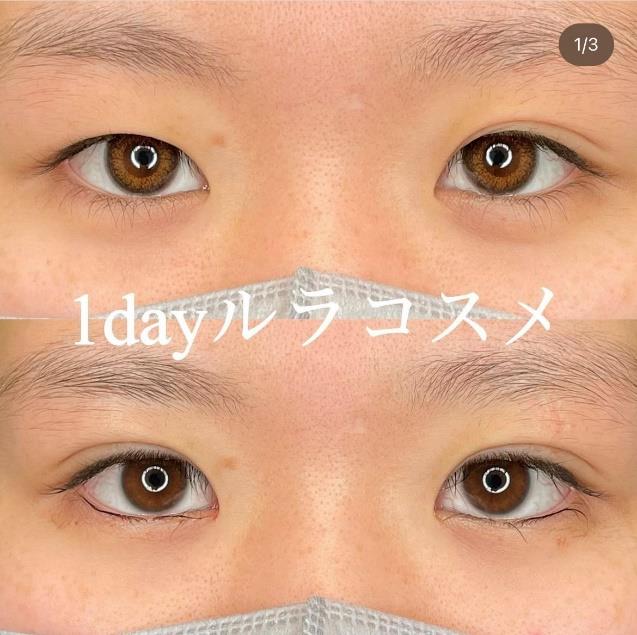 双眼皮手术