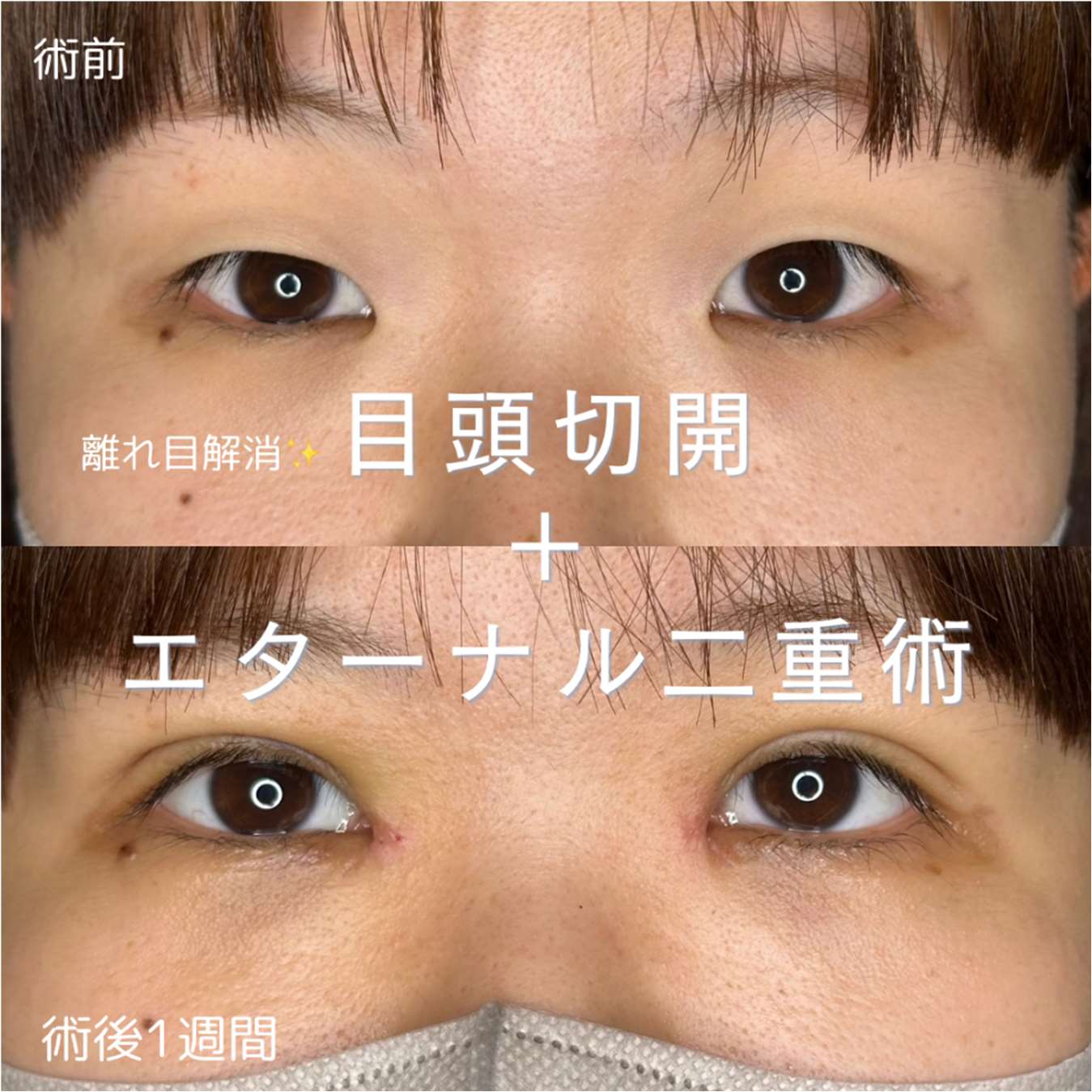 双眼皮手术 + 开眼角