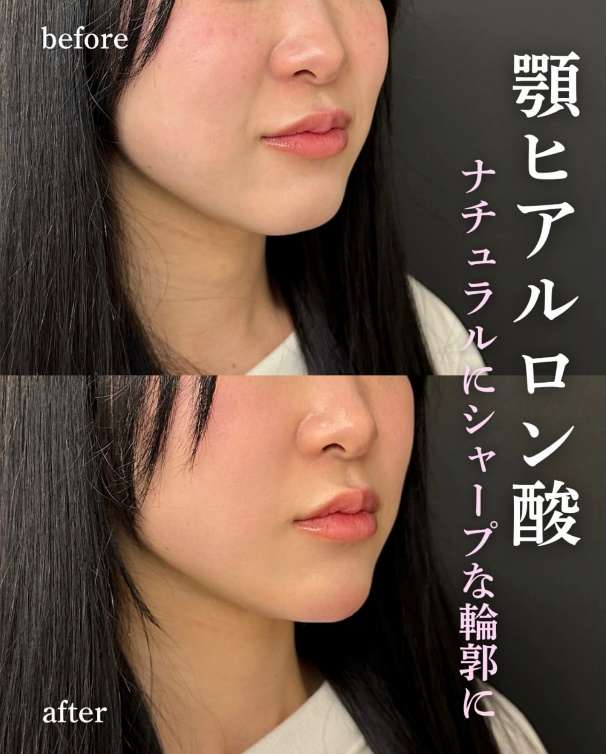 玻尿酸填充