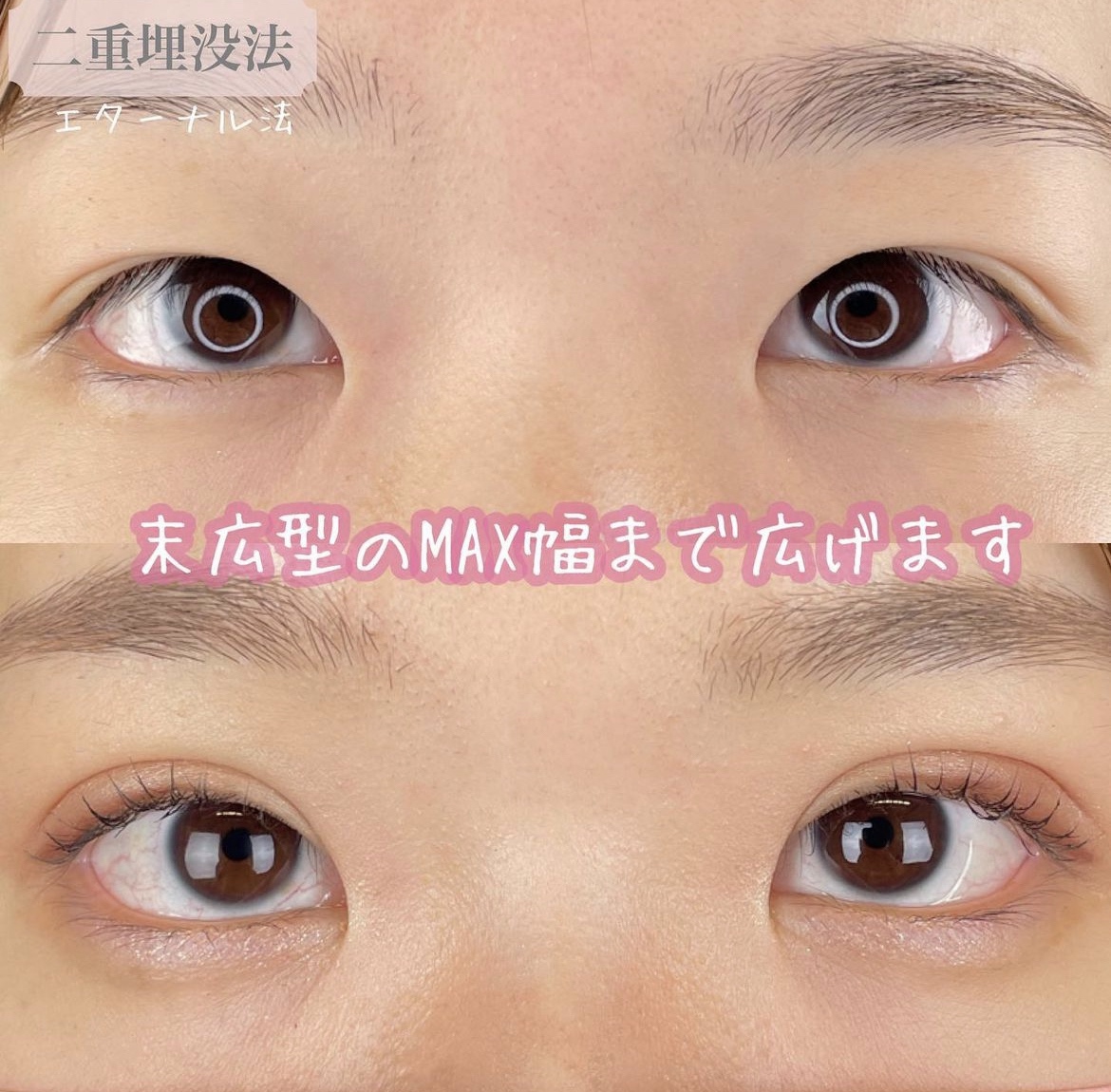 双眼皮手术