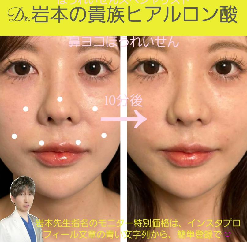 玻尿酸填充