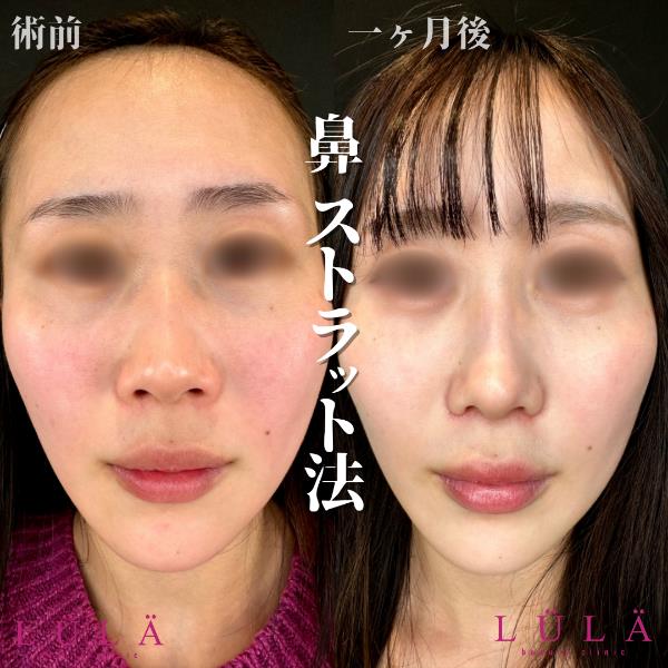 鼻综合整形 + 鼻尖整形 - 切开法