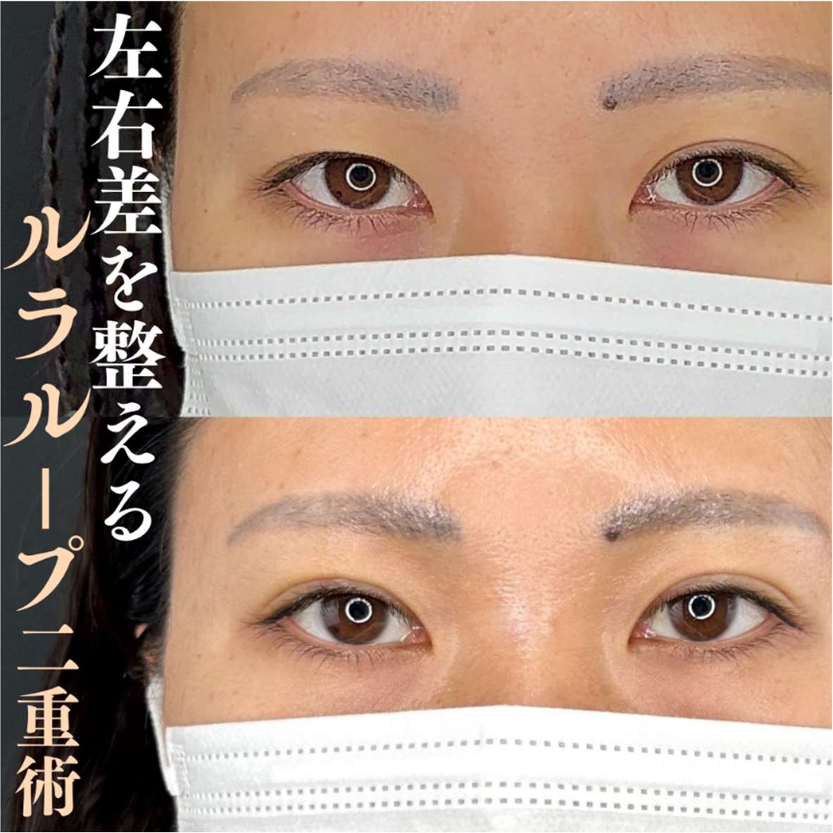 双眼皮手术