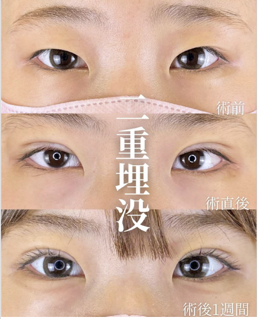 双眼皮手术