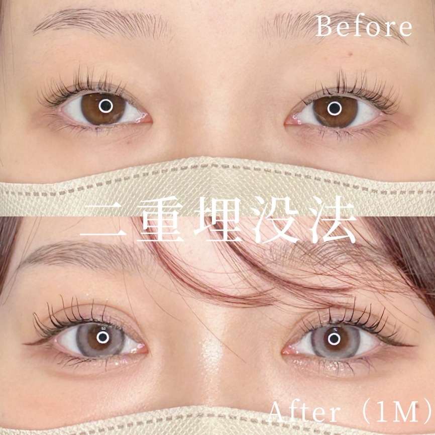 双眼皮手术