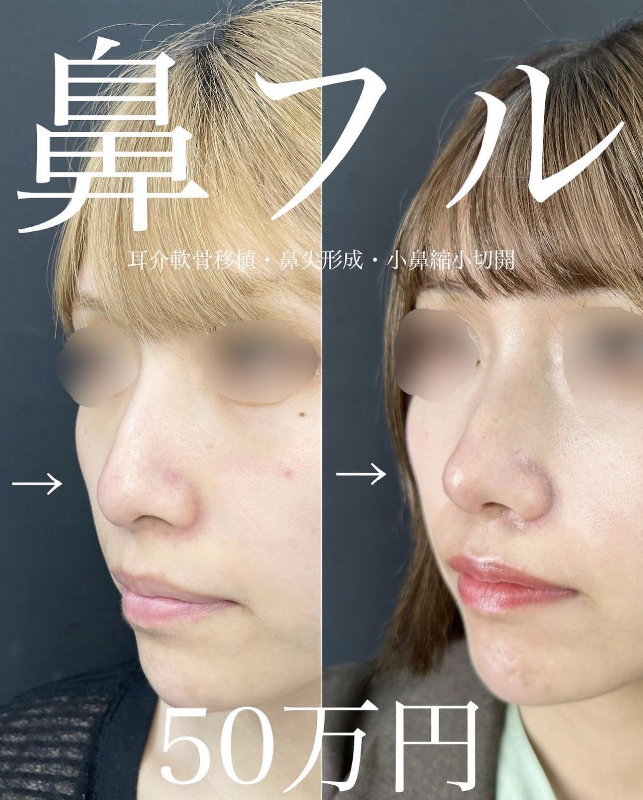 鼻综合整形 + 鼻尖整形 - 切开法