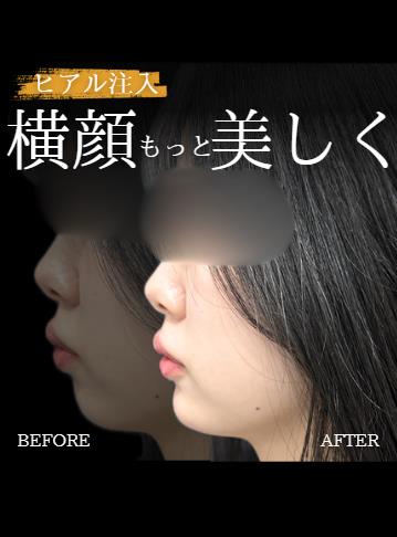 玻尿酸填充