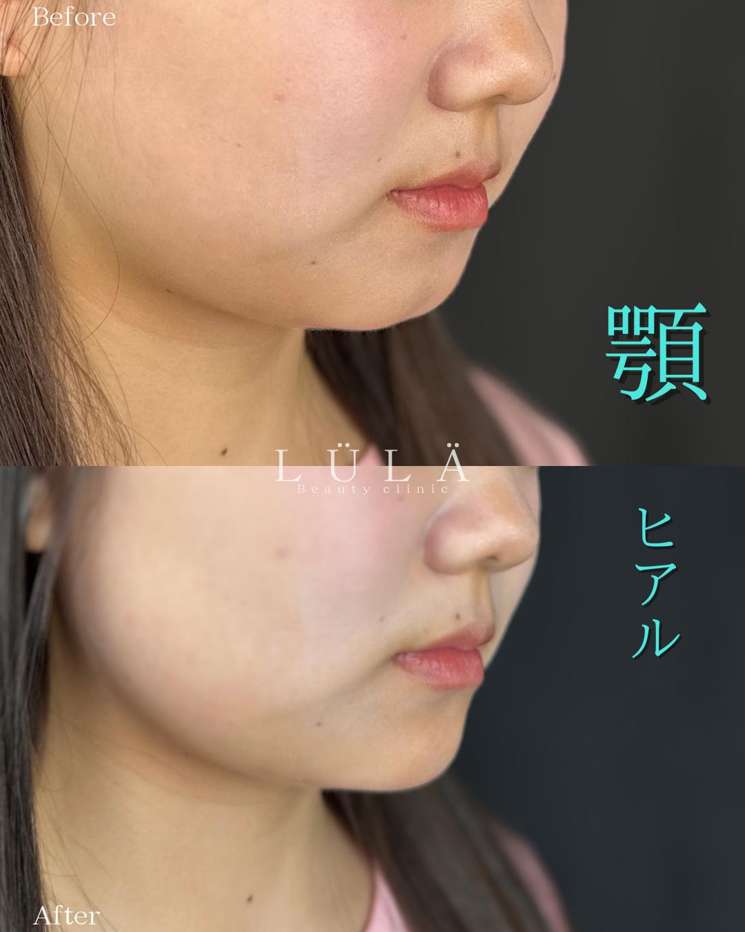 玻尿酸填充