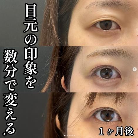 双眼皮手术