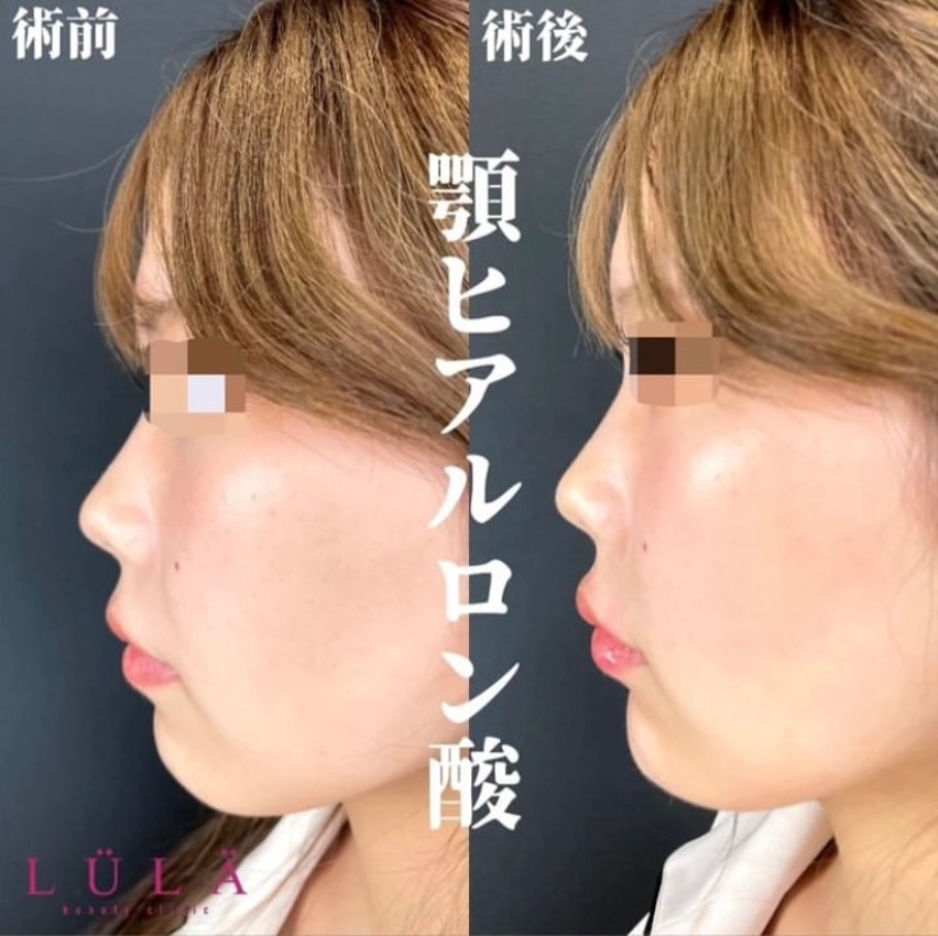 玻尿酸填充