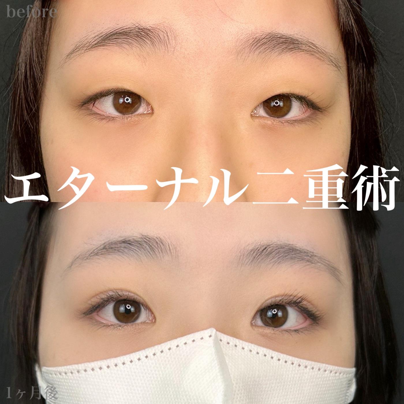 双眼皮手术