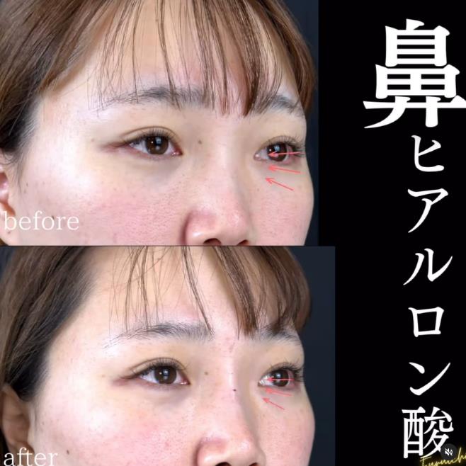 玻尿酸填充